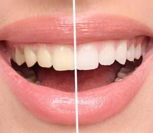 Teeth Whitening Gerrards Cross Face Teeth Smile