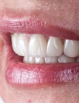 Dental Implants Chalfont St Peter - Gerrards Cross - Face Teeth Smile