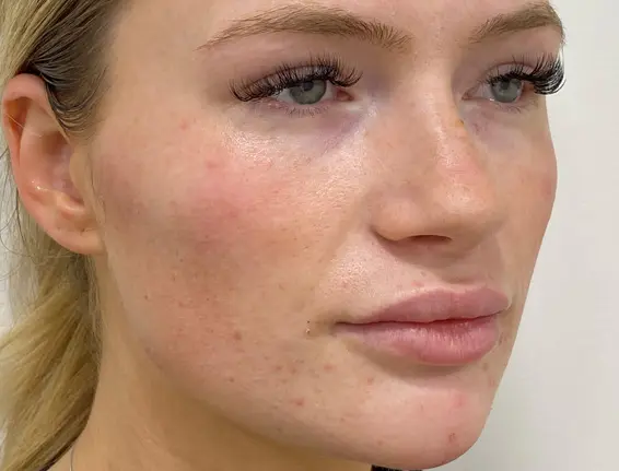 After cheek fillers Buckinghamshire
