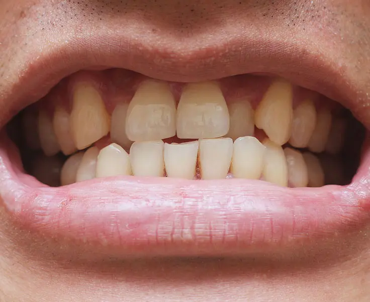 https://faceteethsmile.com/wp-content/uploads/2022/01/FTS-Crowded_Teeth-Section3-1.jpg
