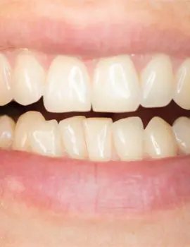 FTS-Crowded_Teeth-Thumbnail
