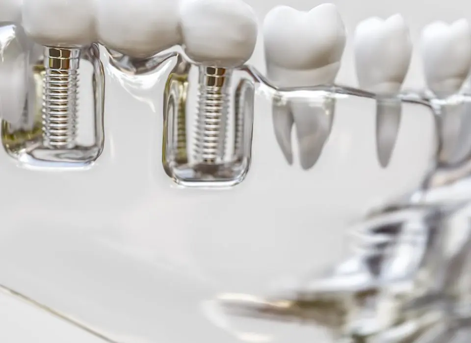 Dental Implants Gerrards Cross