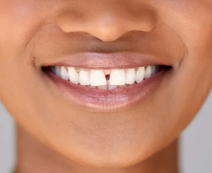 https://faceteethsmile.com/wp-content/uploads/2022/01/FTS-Gap_Teeth-Section3-1.jpg