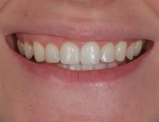 FTS-Invisalign_&_Composite_Bonding-Case1_After