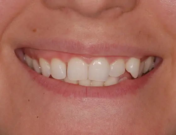 FTS-Invisalign_&_Composite_Bonding-Case1_Before