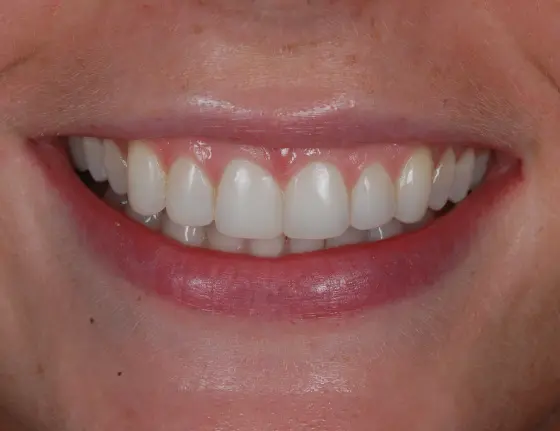 FTS-Invisalign_&_Composite_Bonding-Case6_After