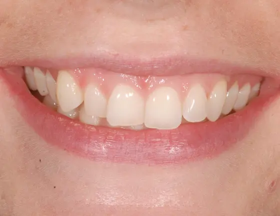 FTS-Invisalign_&_Composite_Bonding-Case6_Before