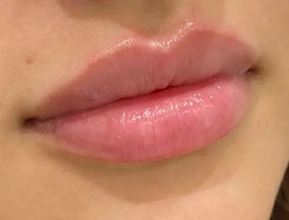 After natural looking lip fillers