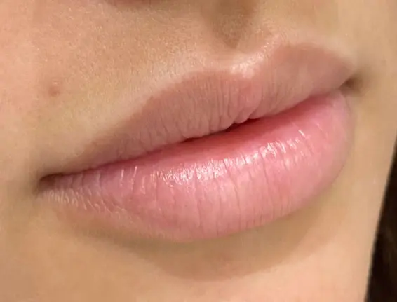 Before natural looking lip fillers