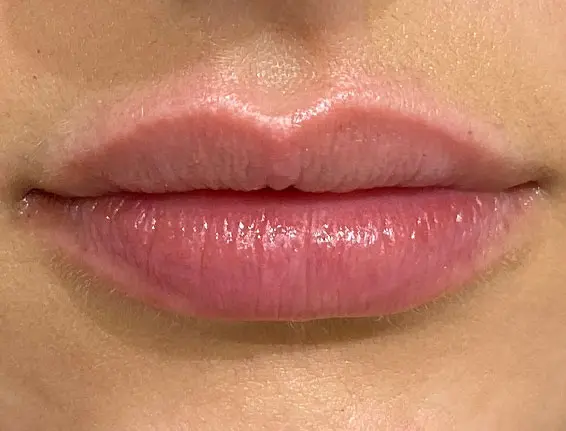 After lip augmentation Chalfont St Peter