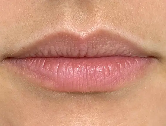 Before lip augmentation Chalfont St Peter
