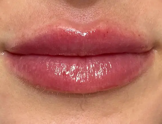 After lip enhancement Chalfont St Peter