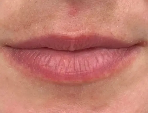 Before lip enhancement Chalfont St Peter