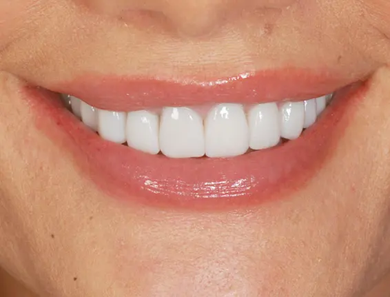 After facial veneers