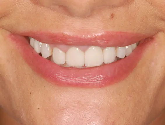 Before facial veneers