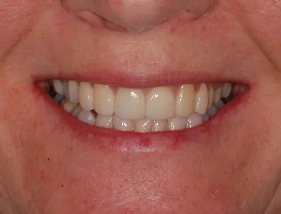 After dental veneers