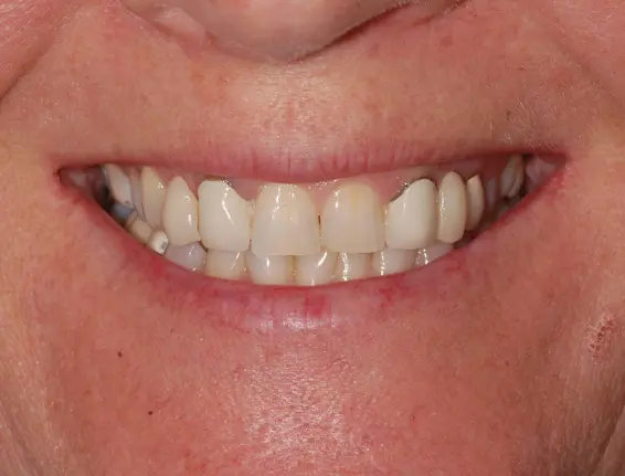 Before dental veneers