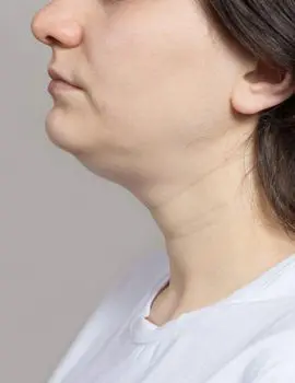 FacialVolumeLoss-Thumb