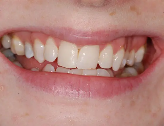 After white spot removal teeth