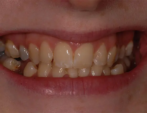 Before white spot removal teeth
