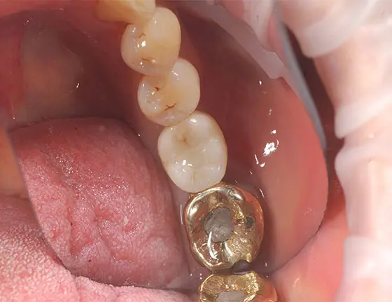 After cosmetic teeth implants