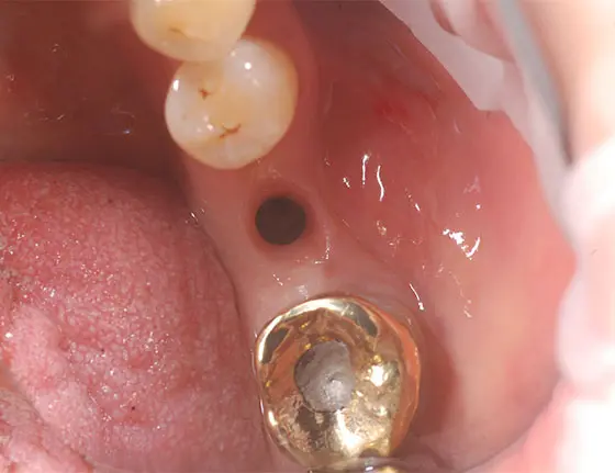 Before cosmetic teeth implants