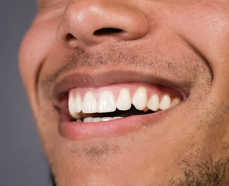 https://faceteethsmile.com/wp-content/uploads/2022/02/FTS-Gummy_Smile-Section3-1.jpg