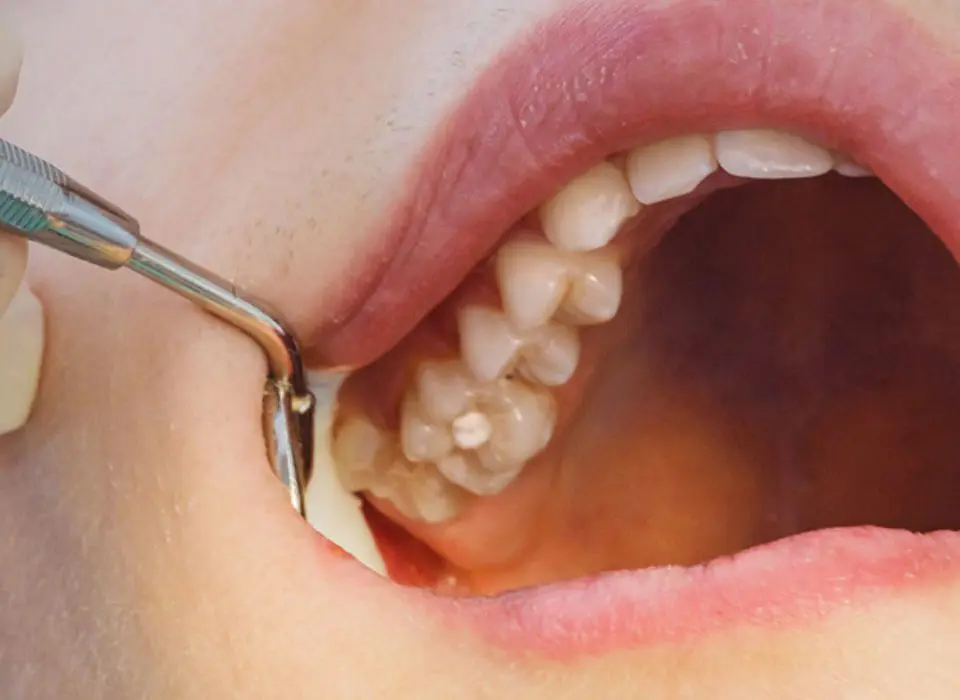 FTS-Lost_Filling-Section1