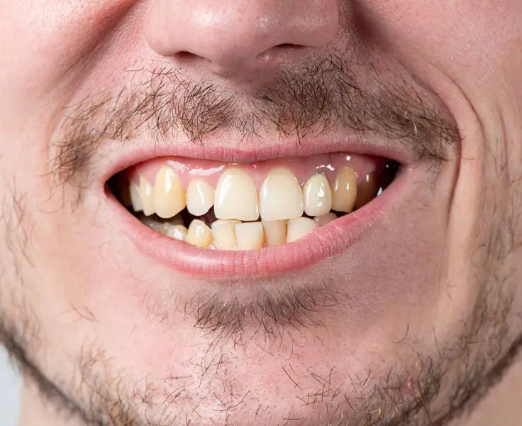https://faceteethsmile.com/wp-content/uploads/2022/02/FTS-Misshapen_Teeth-Section3-1.jpg