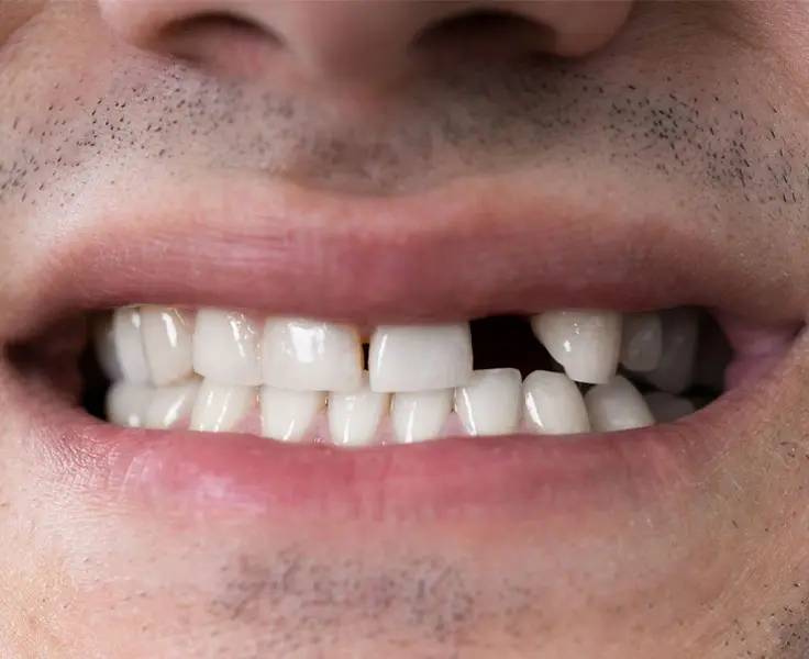 https://faceteethsmile.com/wp-content/uploads/2022/02/FTS-Missing_Teeth-Section3-1.jpg