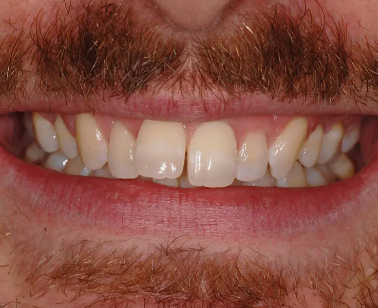 https://faceteethsmile.com/wp-content/uploads/2022/02/FTS-Overbite_and_Underbite-Section2-1.jpg