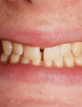 FTS-Overbite_and_Underbite-Thumbnail