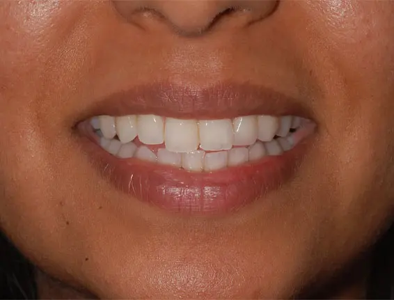 Before whitening