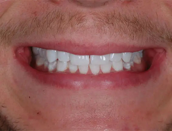 After tooth whitening