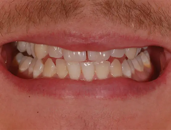 Before tooth whitening