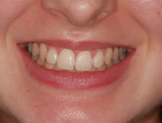 Before teeth whitener