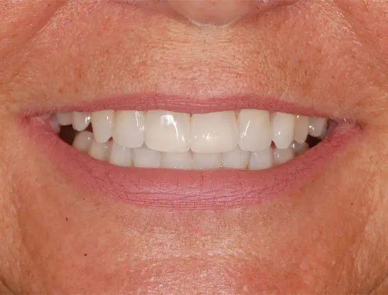 FTS-Teeth_Whitening-Case4-After