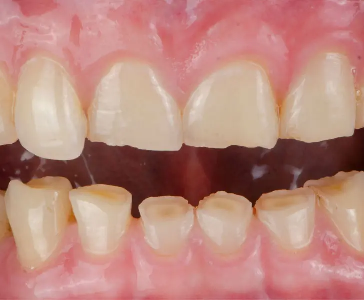 https://faceteethsmile.com/wp-content/uploads/2022/02/FTS-Worn_Teeth-Section2-1.jpg