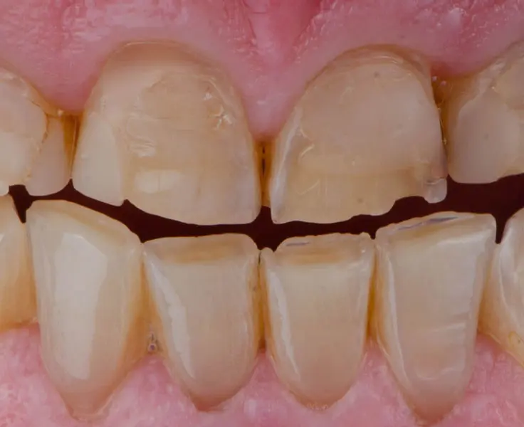 https://faceteethsmile.com/wp-content/uploads/2022/02/FTS-Worn_Teeth-Section3-1.jpg