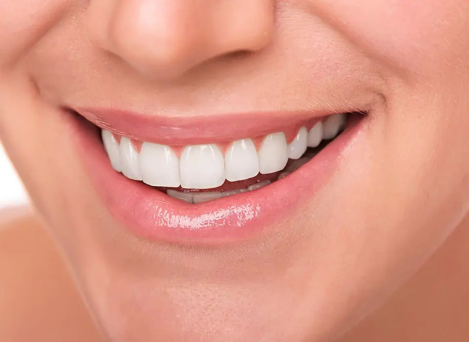 Veneers Buckinghamshire