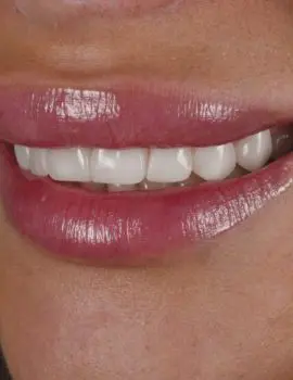 Face Teeth Smile - Milled Composite Veneers