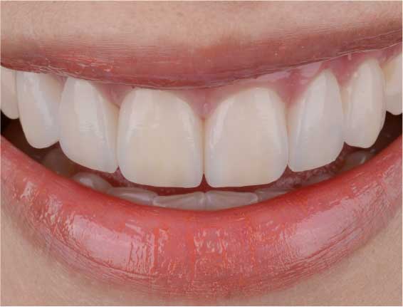 Invisalign teeth straightening AFTER