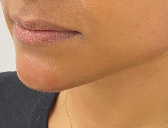 After chin and jaw filler Gerrards Cross