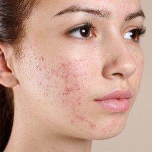 Acne Treatment Gerrards Cross