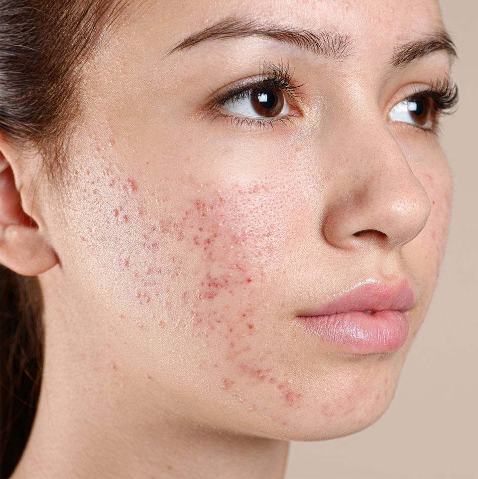 Acne and Acne Scarring Treatments | Face Teeth Smile | Gerrards Cross