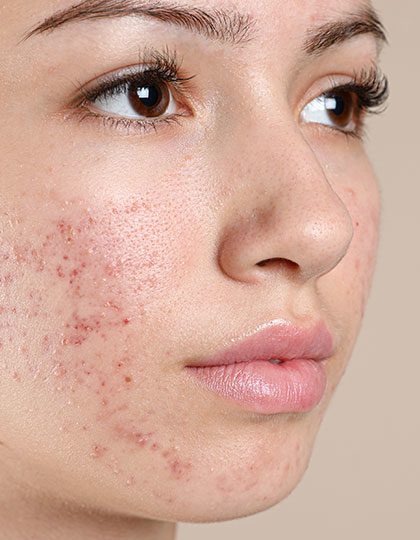 ACNE AND ACNE SCARRING