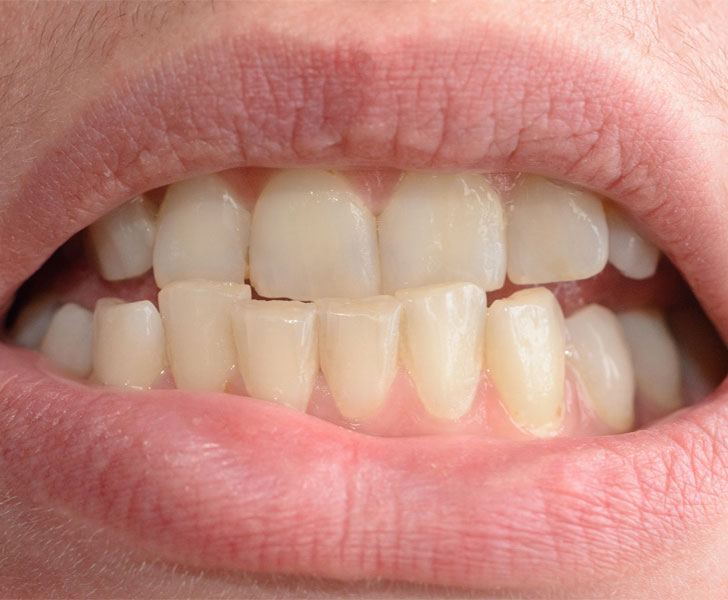 https://faceteethsmile.com/wp-content/uploads/2022/01/FTS-Crowded_Teeth-Section2-1.jpg
