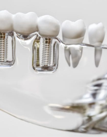 Why replace missing teeth with dental implants?