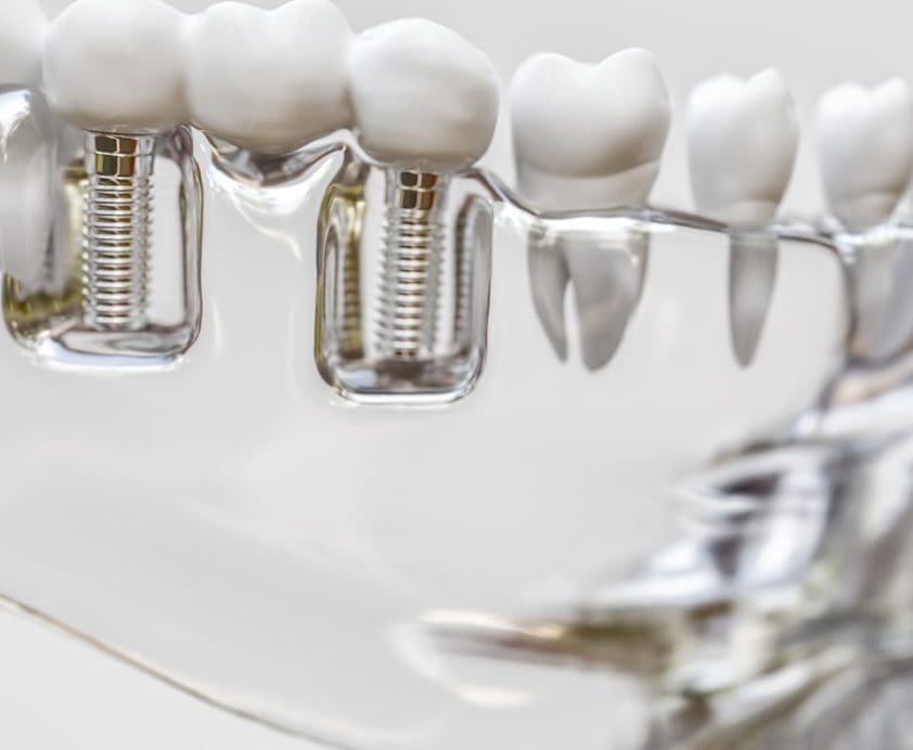 Why replace missing teeth with dental implants?