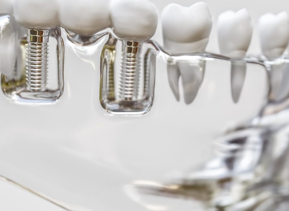 Dental Implants Gerrards Cross
